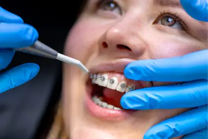 Brackets La Ortodoncia Más Elegida