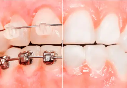 Comparativa Entre Ortodoncias